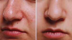 Pores, Blackhead, Steam, Charcoal, Exfoliation