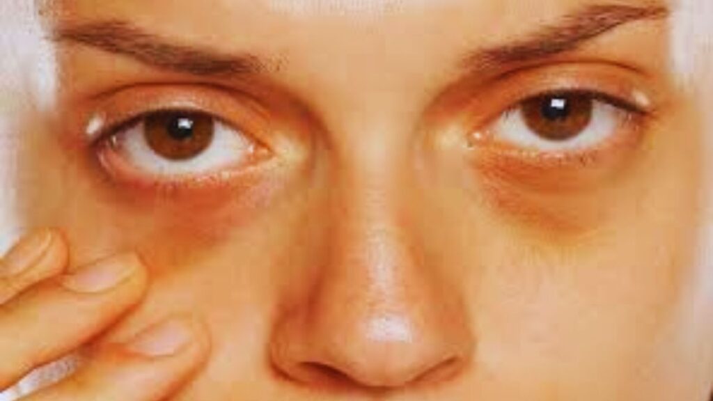 Under Eye, Dark Circle, Green tea, Nutrition, Sleep, Ice