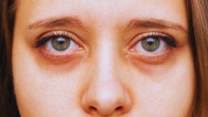 Under Eye, Dark Circle, Green tea, Nutrition, Sleep, Ice